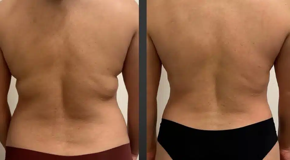 Before and after images of Multishape treatment on the flanks, showcasing reduced side fat and a more sculpted body shape.