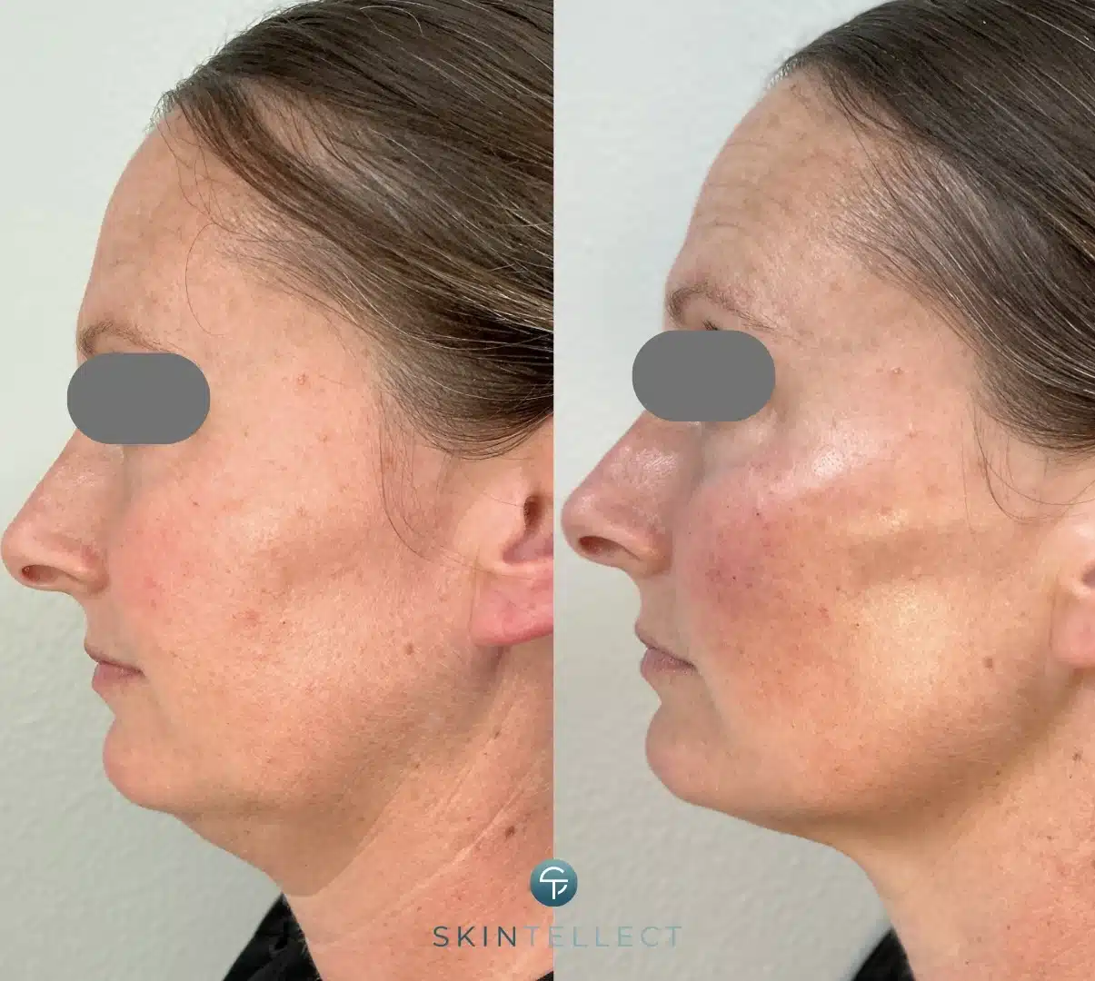 Side profile before and after 3.5 syringes of cheek filler, showing lifted cheeks and reduced appearance of a double chin.