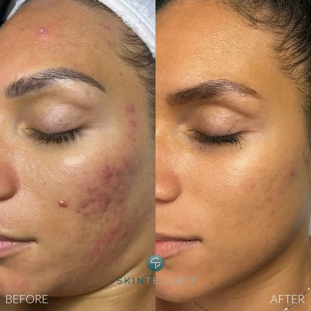 Before and after acne treatment with microneedling and chemical peels at Skintellect Laser & Aesthetics in Tampa, FL – visible reduction in acne, scarring, and redness.