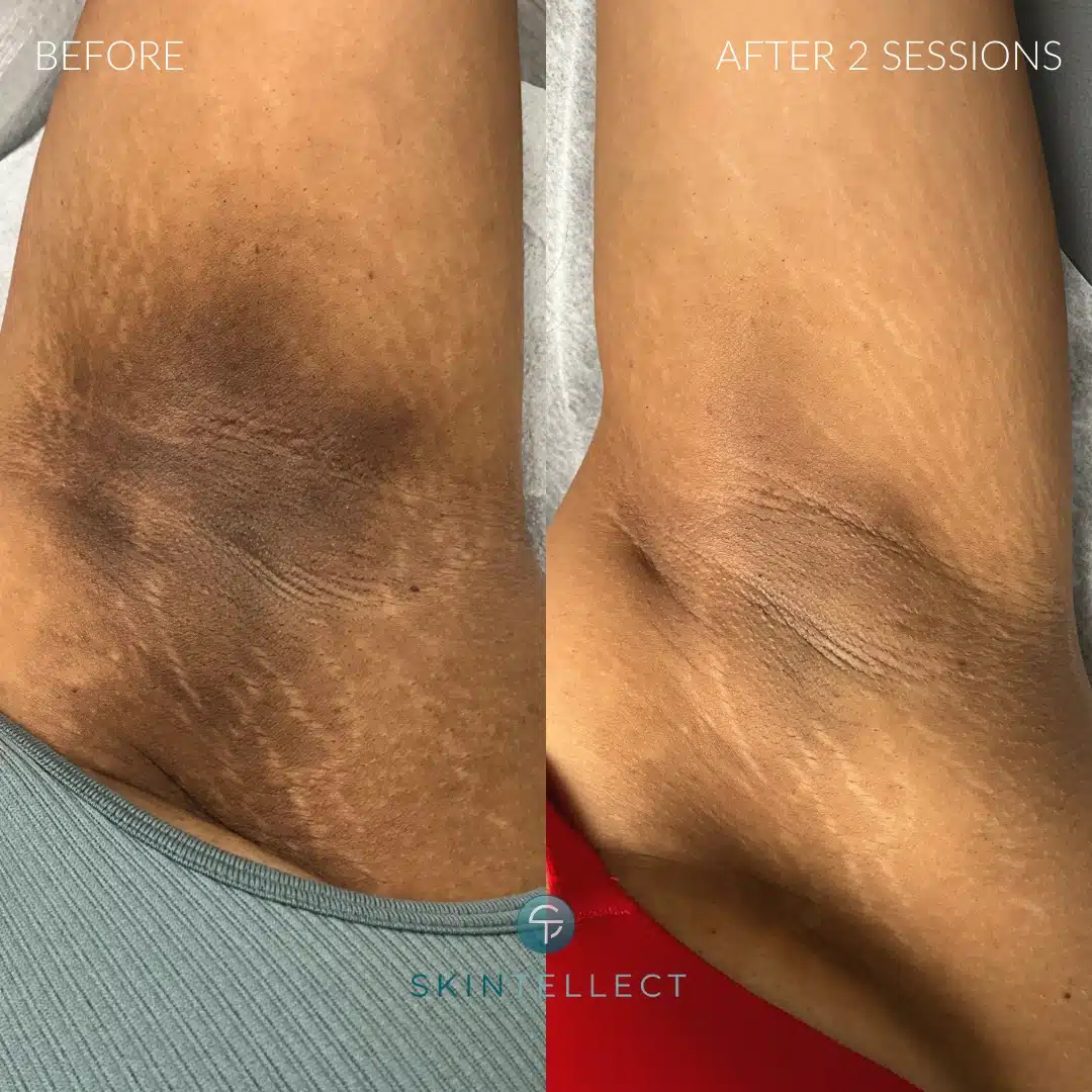 Laser Intimate Skin Lightening 2 Sessions for lightening dark hyperpigmentation on underarms