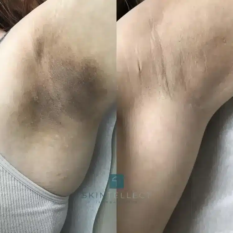 Before and after of laser intimate lightening treatment on underarms for a brighter skin tone.