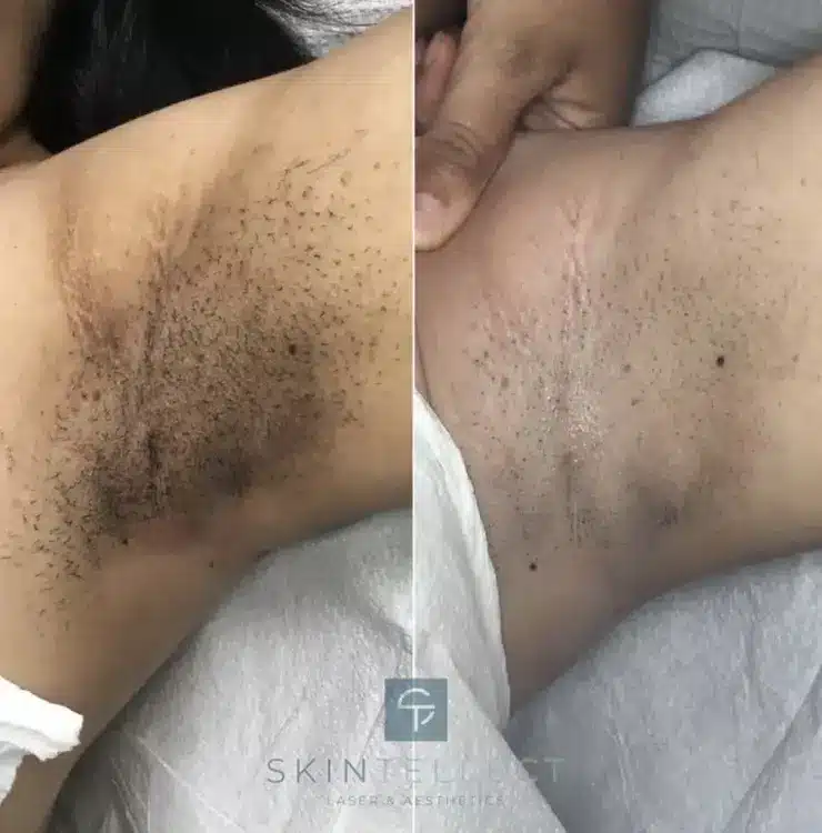 Before and after of underarm laser intimate lightening for a smoother, brighter skin appearance.