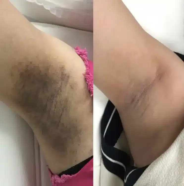 Before and after results of underarm laser intimate lightening, brightening dark skin.