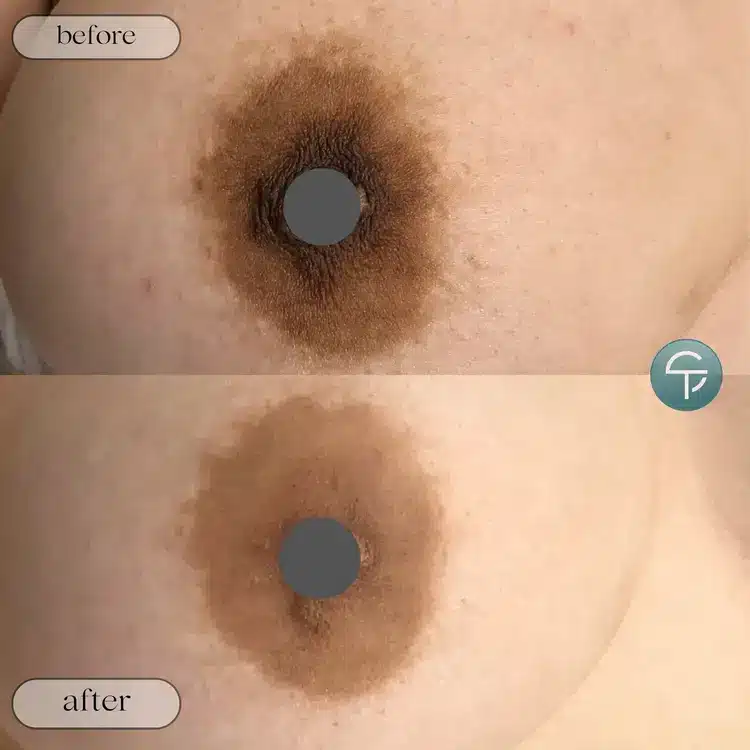 Before and after of laser intimate lightening for areola area, offering a more even skin tone.