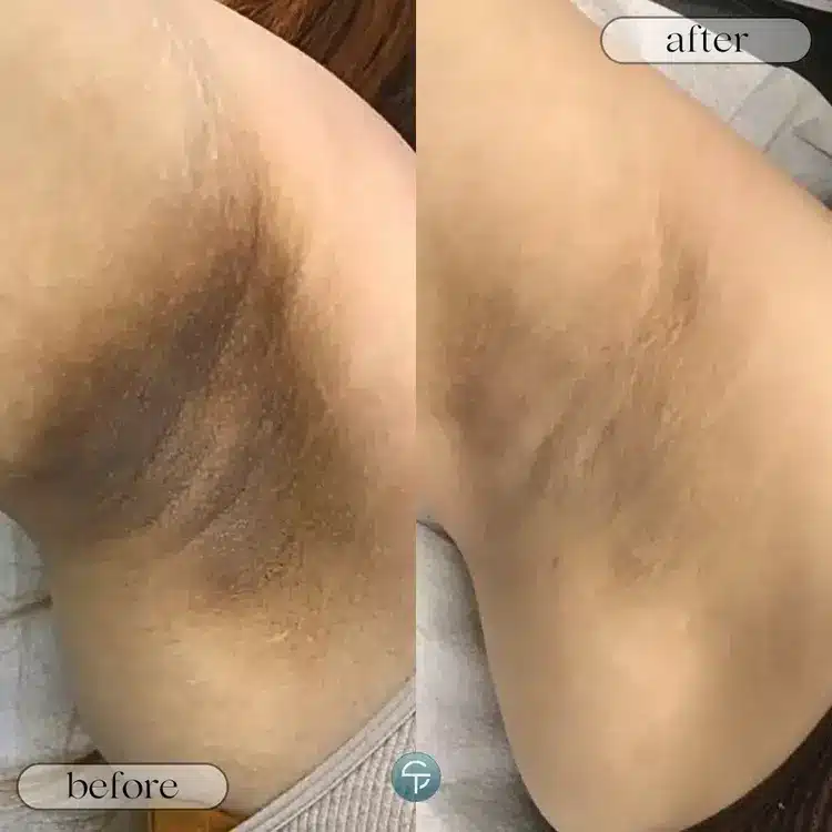 Before and after of underarm intimate lightening treatment showing improvement in skin clarity.