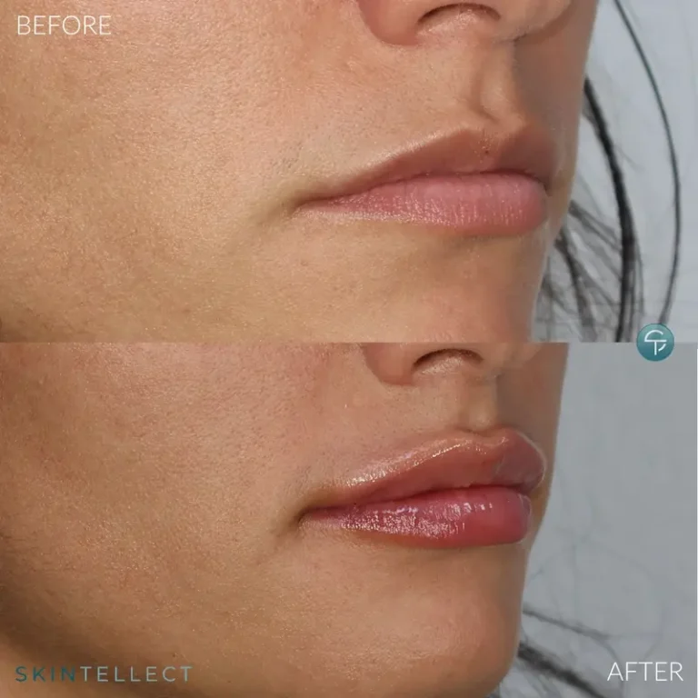 Before and after photo showing natural lip enhancement with 1 syringe of dermal filler at Skintellect Laser & Aesthetics in Tampa.