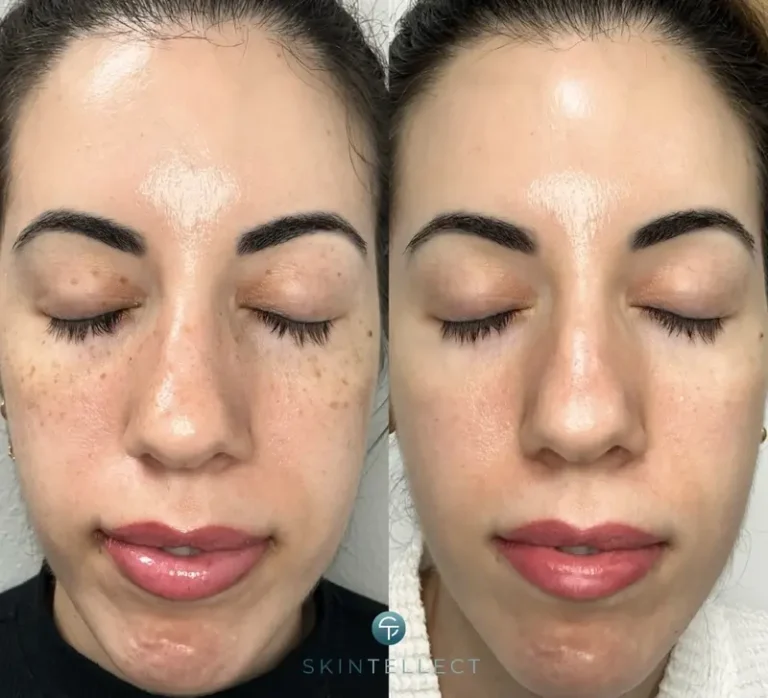 Before and after image showing reduction of facial dark spots and pigmentation after laser treatment.