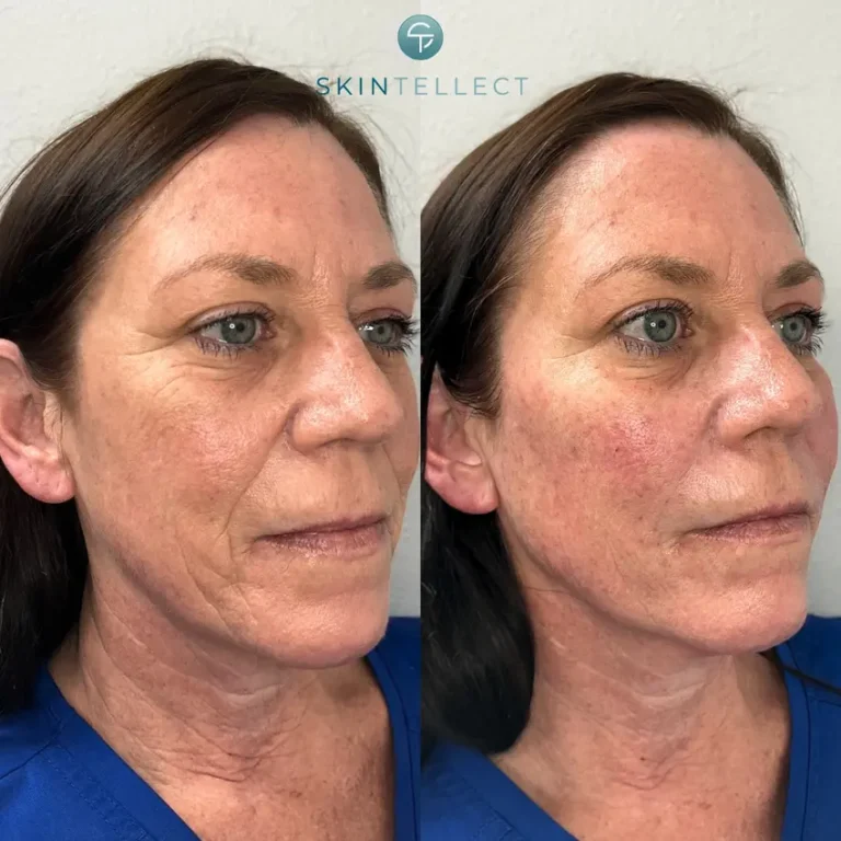 Face before and after two vials of Sculptra, showing smoother lines, added volume, and a more youthful, fuller appearance.
