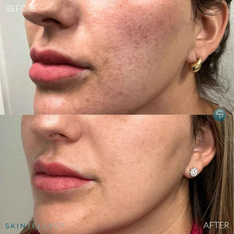 Before and after photo showing improvement in textured and pigmented acne scars following professional skin treatments.