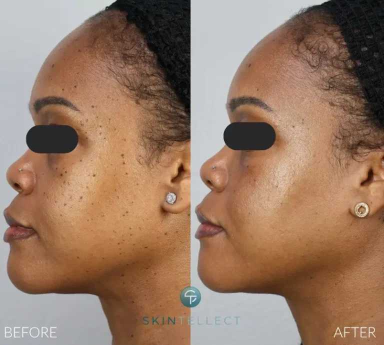 Before and after DPN removal at Skintellect Laser & Aesthetics in Tampa, showing smoother, spot-free skin.