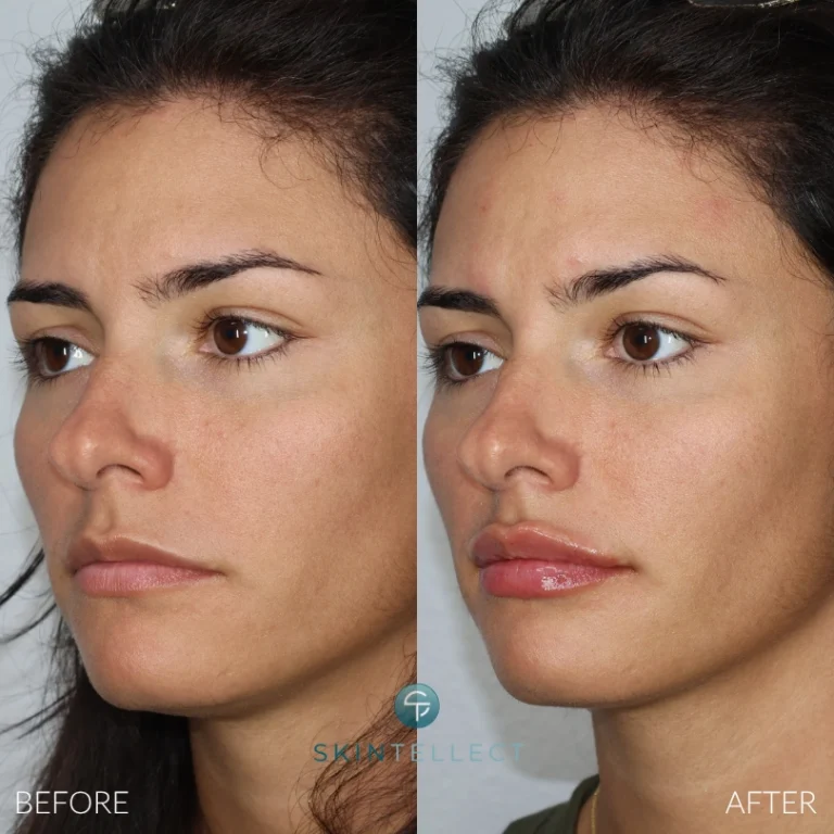 Before and after photo showing lip enhancement with one syringe of dermal filler at Skintellect Laser & Aesthetics in Tampa.