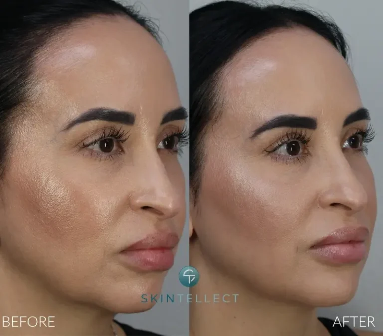 Before and after photo showing Botox and dermal filler treatment for cheek and jawline contouring at Skintellect Laser & Aesthetics in Tampa.