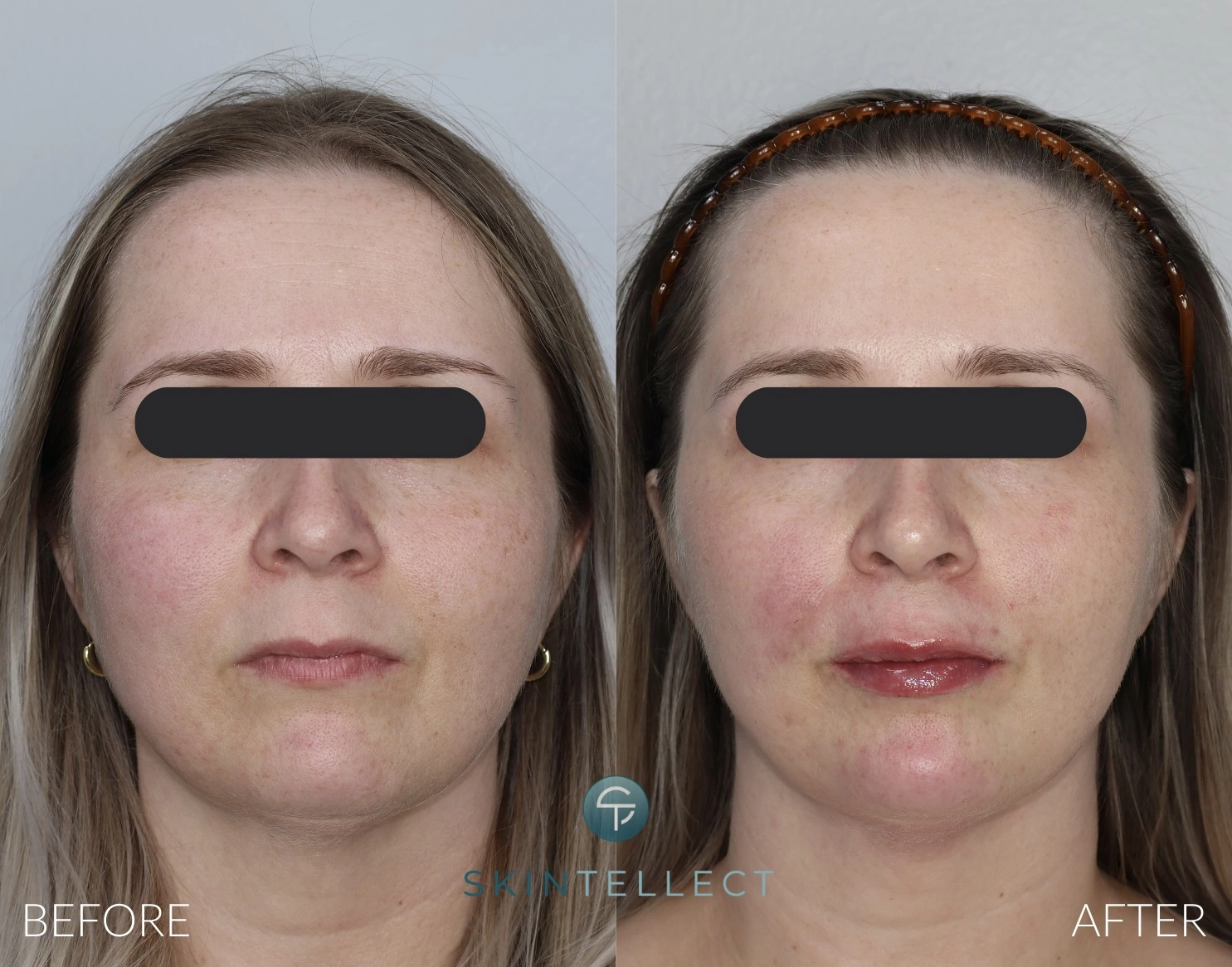 Full Facial Balancing | Botox & Filler