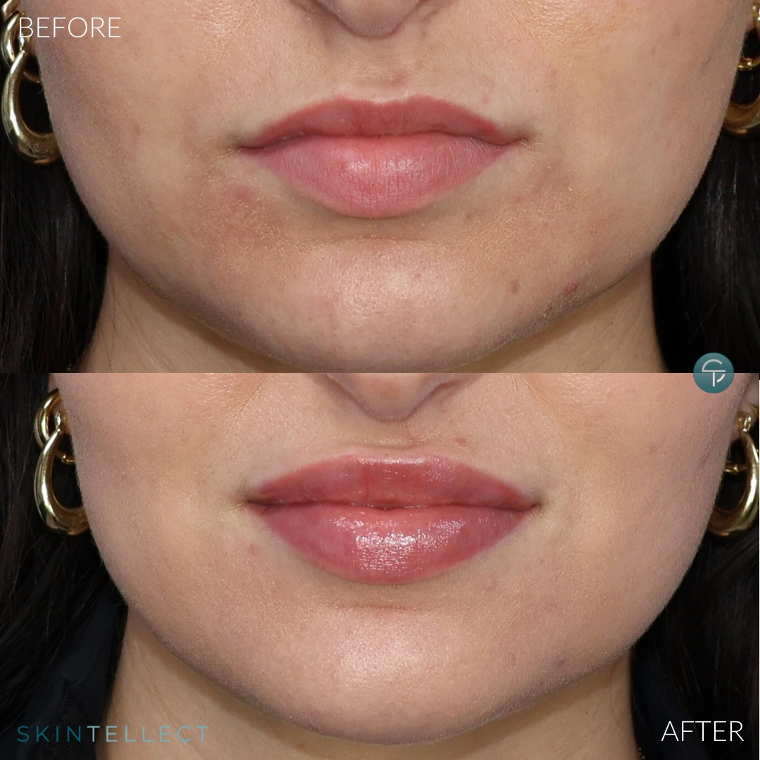 Lip Filler | 1 Syringe