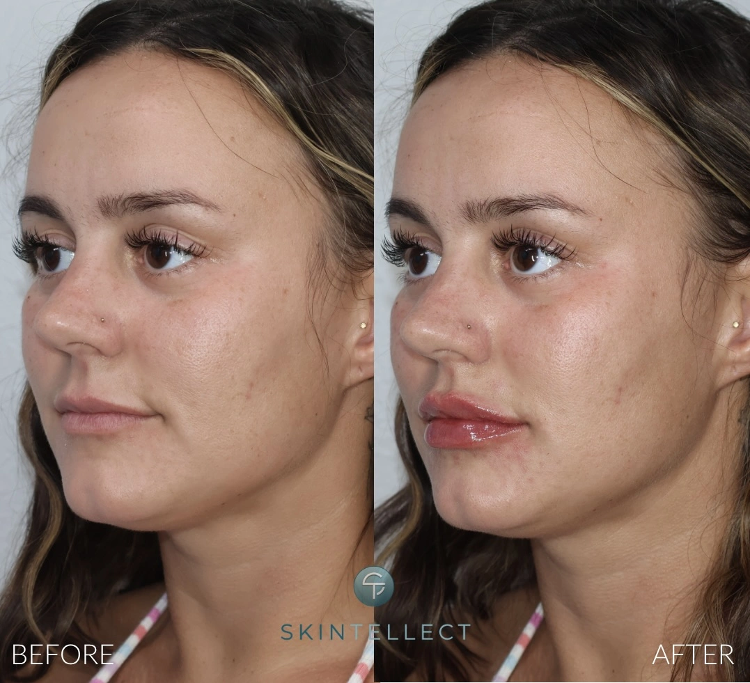 Lip Filler | 1 Syringe