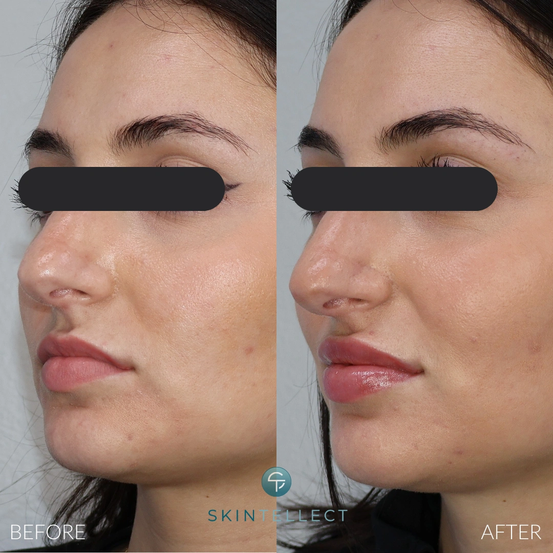 Lip Filler | 1 Syringe