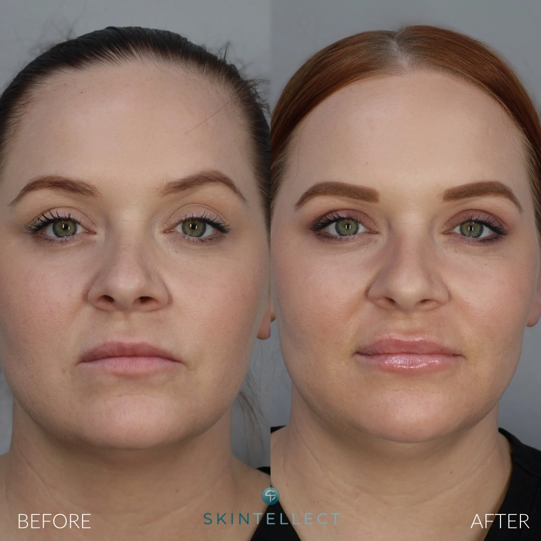 Lip Filler | 1 Syringe