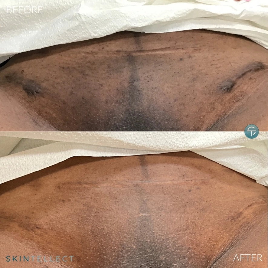 Before and after laser scar removal and laser intimate lightening on darker skin tone