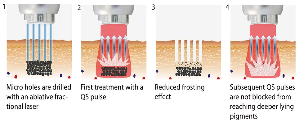 FracTat Tattoo Removal Process