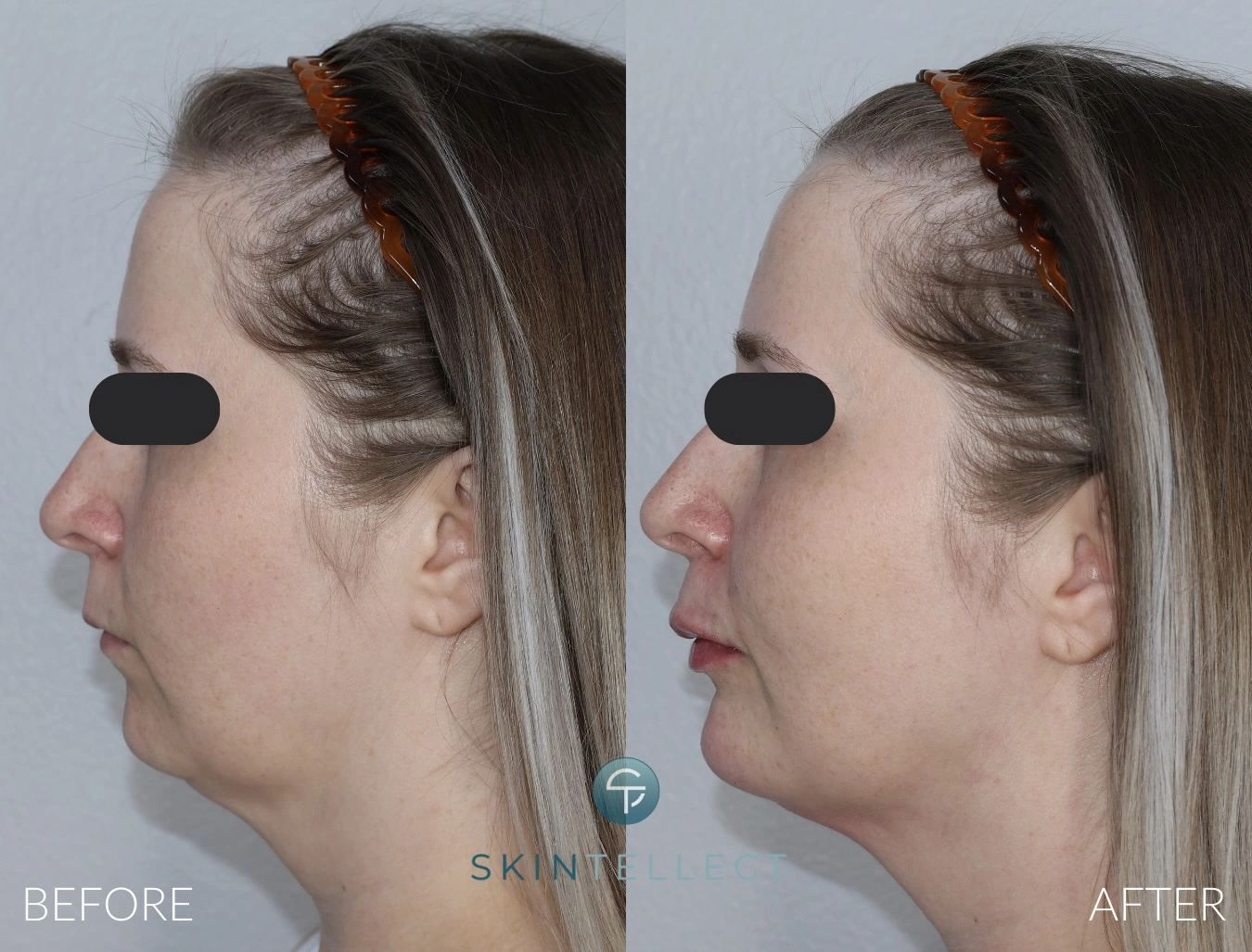 Full Facial Balancing | Botox & Filler