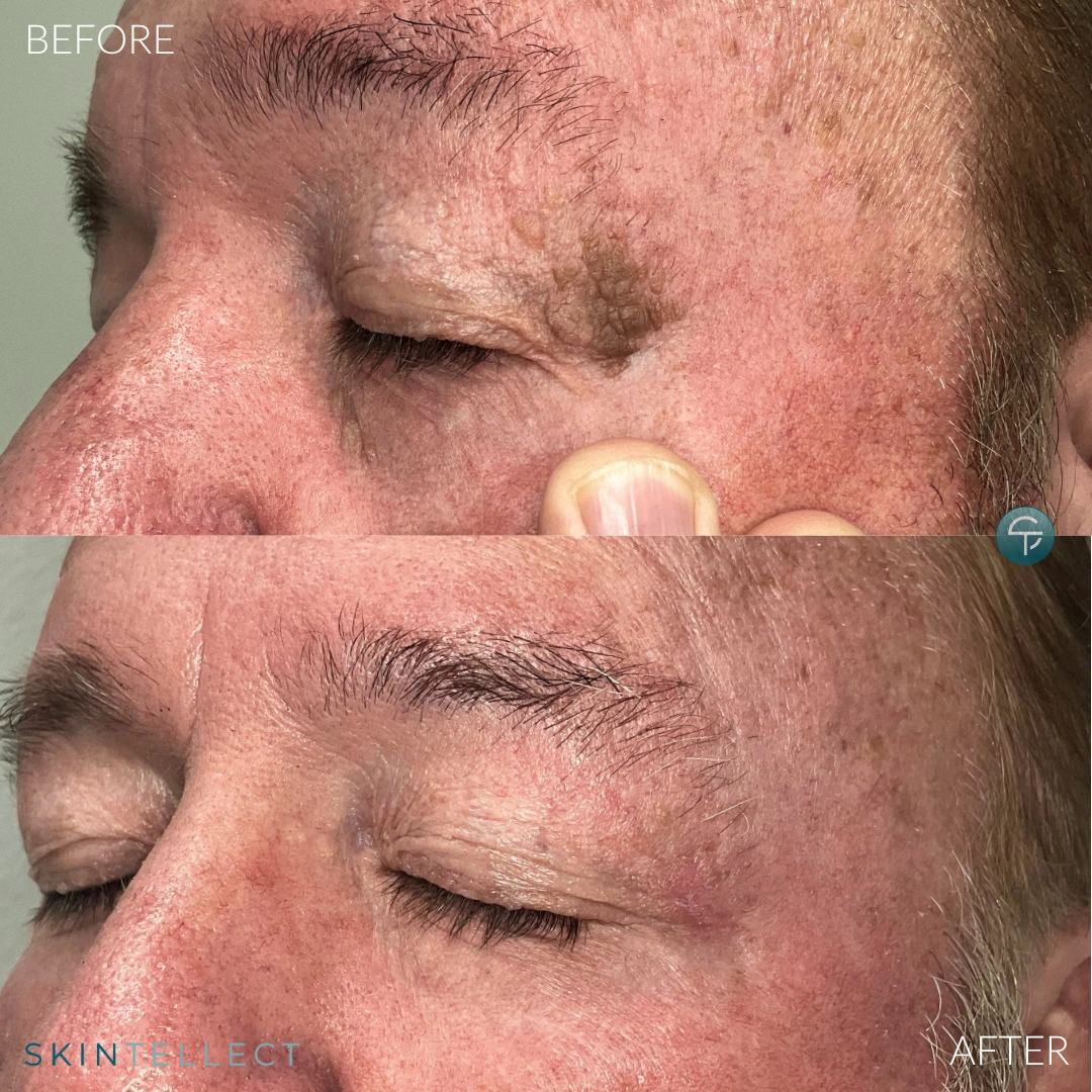 Growth removal before and after