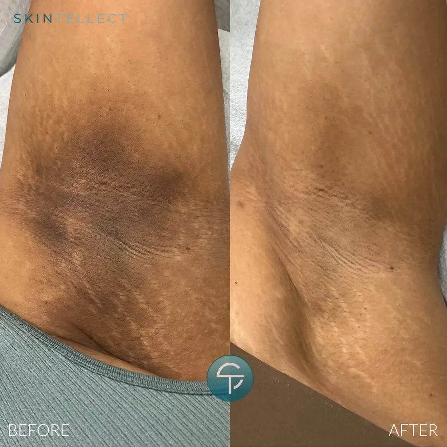 Laser Intimate Lightening Underarms Before & After Skintellect Tampa