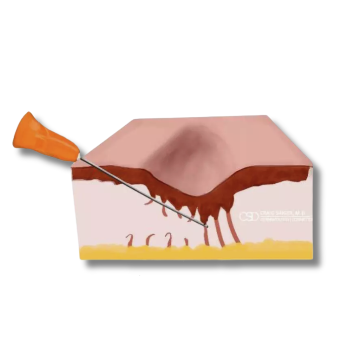 Subcision treatment showing how a laser acne scar procedure releases tethered acne scars by breaking up fibrous bands beneath the skin.