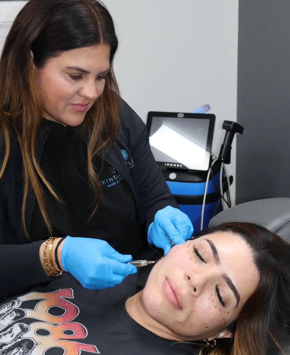 Subcision with PRP treatment at Skintellect Laser & Aesthetics in Tampa for smoothing acne scars and stimulating collagen