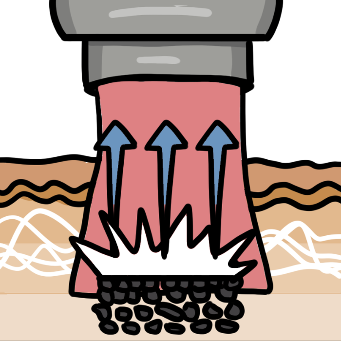 FracTat advanced laser tattoo removal step 2