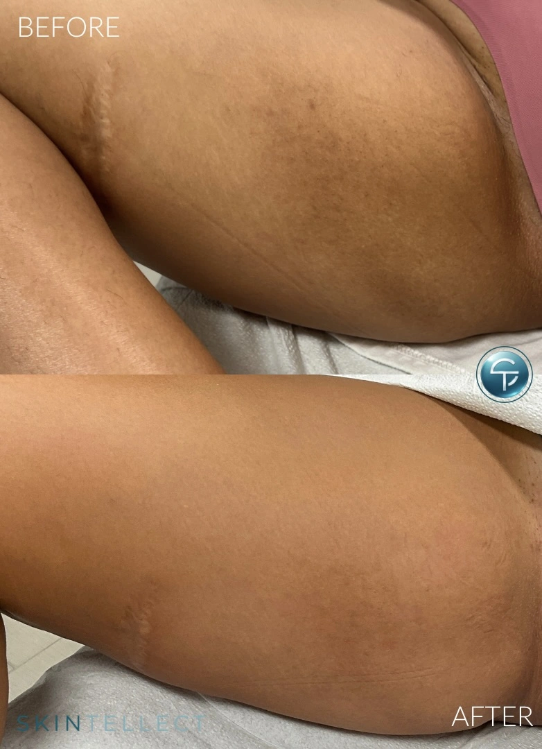 Laser Intimate Lightening | 2 Sessions