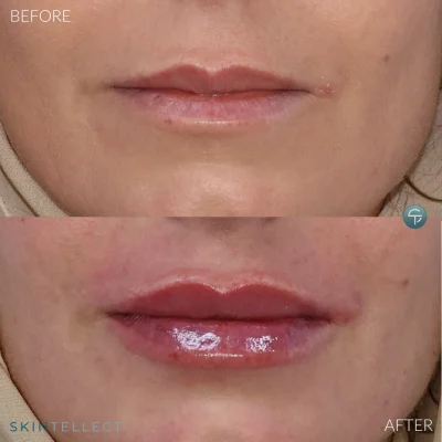Before and after lip filler results at Skintellect Laser & Aesthetics in Tampa Westchase showing natural volume enhancement and improved lip symmetry