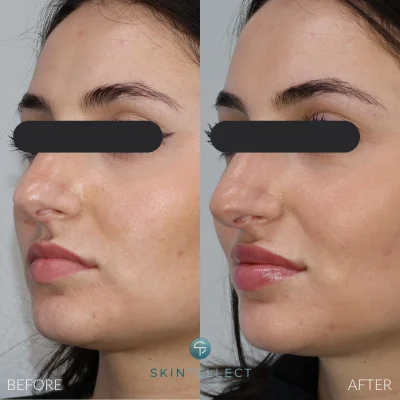 Lip Filler | 1 Syringe