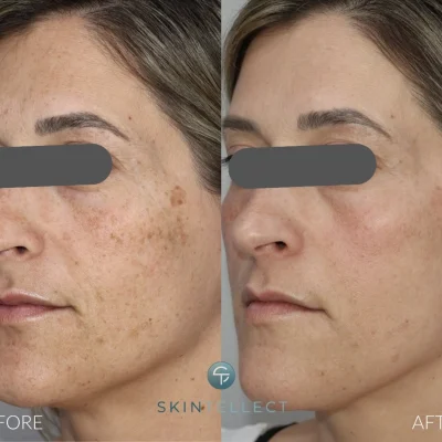 Laser Pigment Removal | 2 Sessions