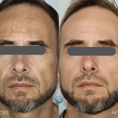 Laser Pigment Removal Before and After Skintellect Tampa
