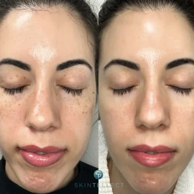 Before and after image showing reduction of facial dark spots and pigmentation after laser treatment.