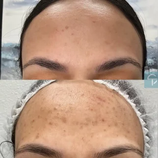 Before and after laser pigment removal showing reduced sunspots on the face.