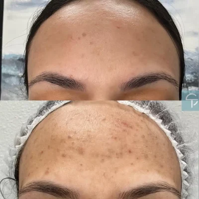 Before and after laser pigment removal showing reduced sunspots on the face.