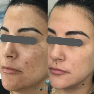 Before and after laser pigment removal treatment reducing dark spots on the face.