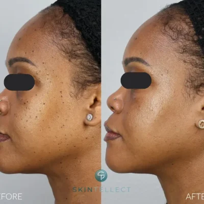 Before and after DPN removal at Skintellect Laser & Aesthetics in Tampa, showing smoother, spot-free skin.