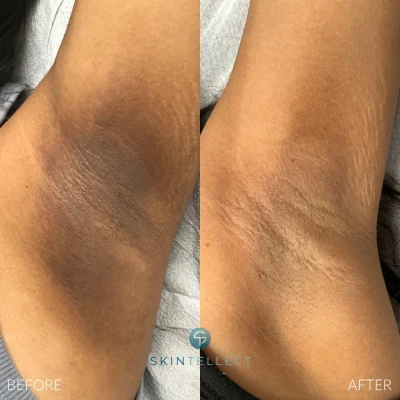 Before and after laser intimate lightening treatment for underarms at Skintellect Laser & Aesthetics in Tampa.