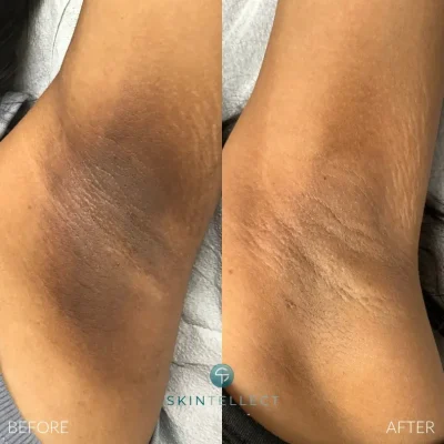 Before and after laser intimate lightening treatment for underarms at Skintellect Laser & Aesthetics in Tampa.