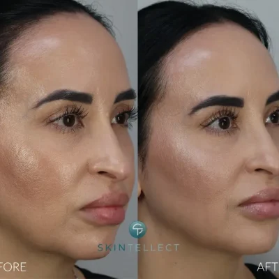 Before and after photo showing Botox and dermal filler treatment for cheek and jawline contouring at Skintellect Laser & Aesthetics in Tampa.