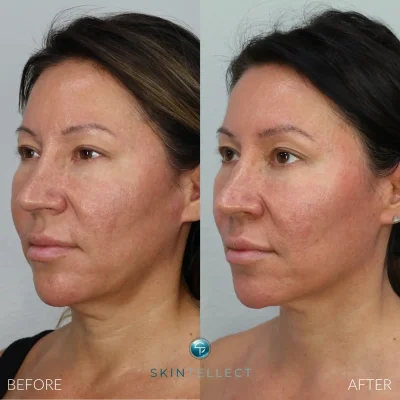 Before and after non-invasive laser facelift using Fotona 4D and Morpheus8 at Skintellect Laser & Aesthetics in Tampa Westchase showing lifted, tighter, and smoother skin