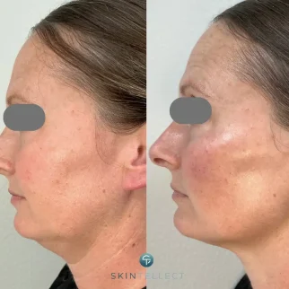 Side profile before and after 3.5 syringes of cheek filler, showing lifted cheeks and reduced appearance of a double chin.
